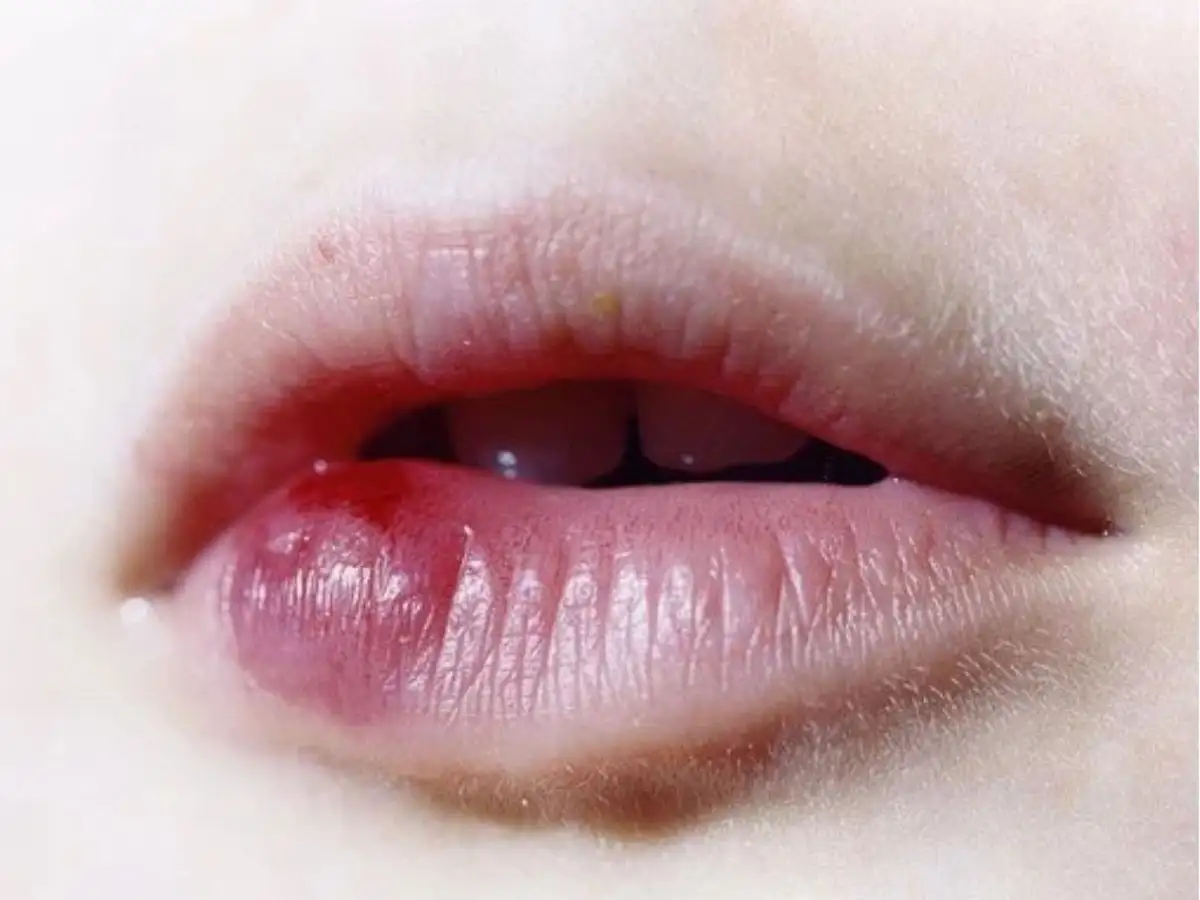 Dấu hiệu bị dị ứng son nguy hiểm