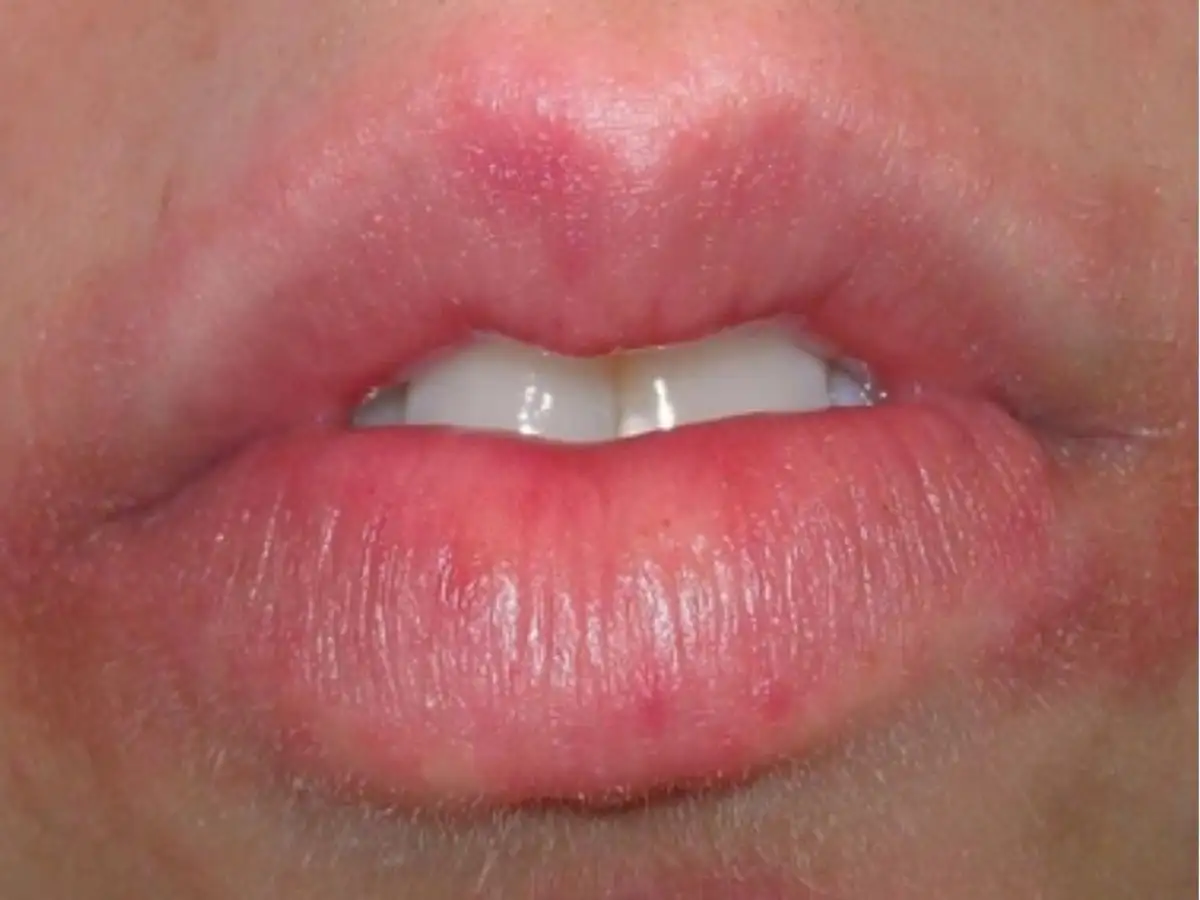 Cảnh báo dị ứng son cực kỳ nguy hiểm
