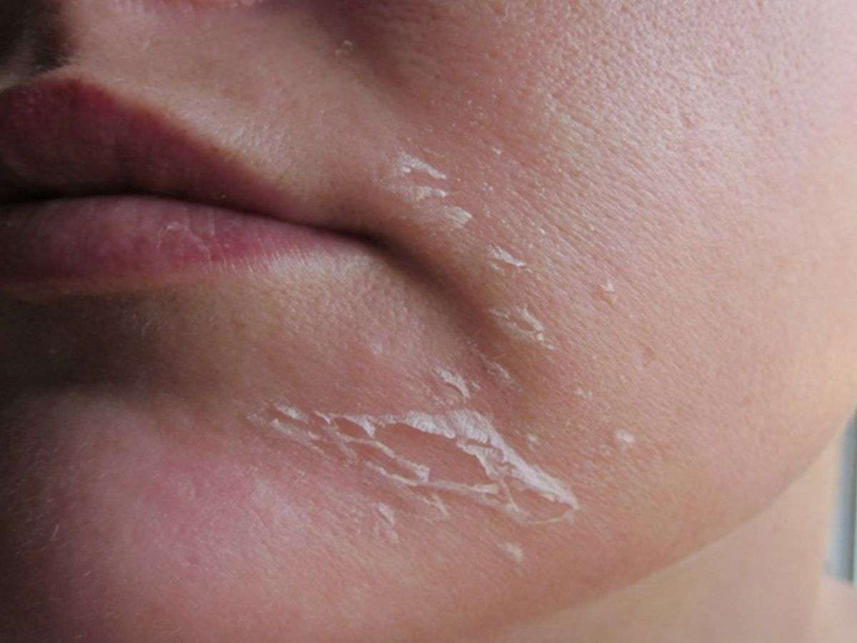 Khả năng hút ẩm mạnh của phấn rôm có thể làm tình trạng da dễ bong tróc