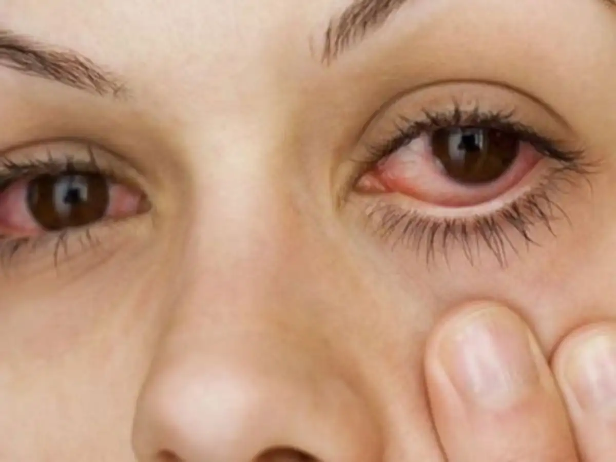 mắt có thể bị đỏ khi bạn sử dụng sản phẩm mascara quá hạn