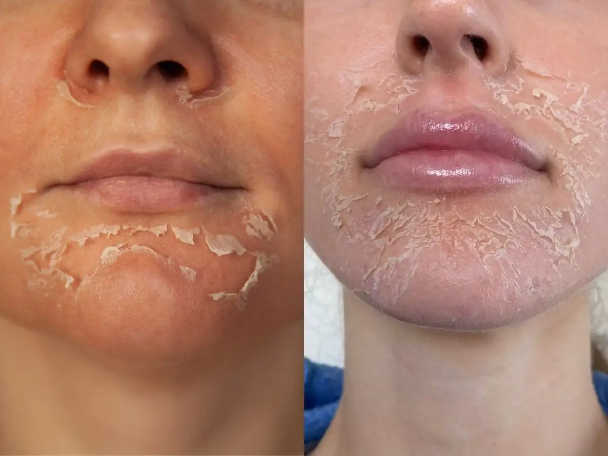 Cần để da bong tróc tự nhiên sau khi peel
