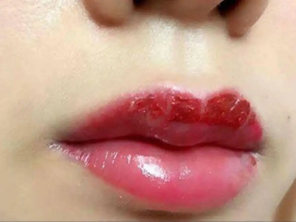 Môi khô, bong tróc, mất nhiều thời gian để môi phục hồi sau phun