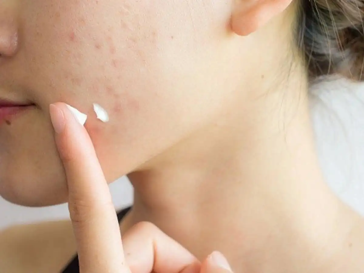 Sử dụng mẹo che mụn và thâm bằng các cách sau