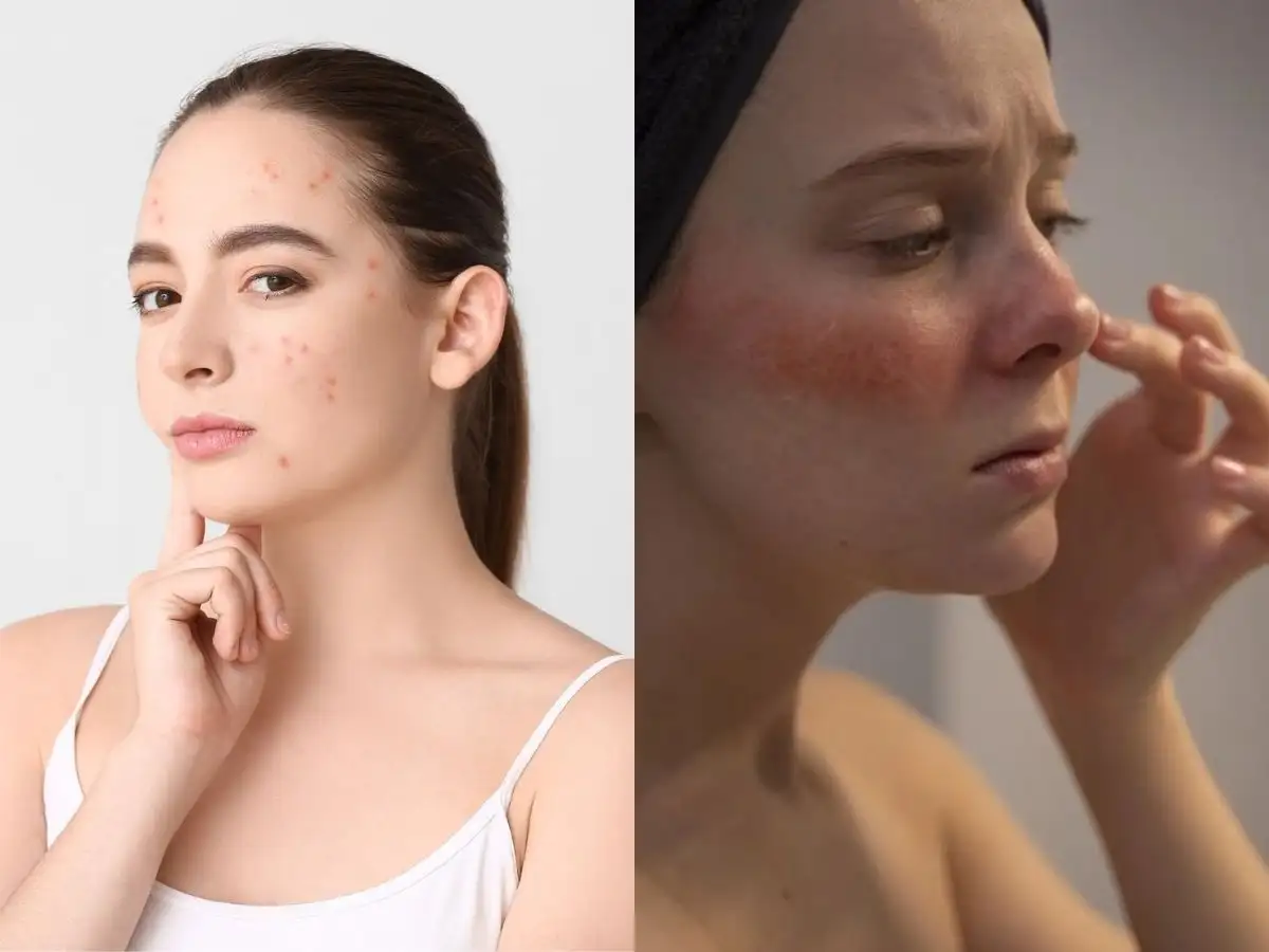 Cách phân biệt đẩy mụn và kích ứng