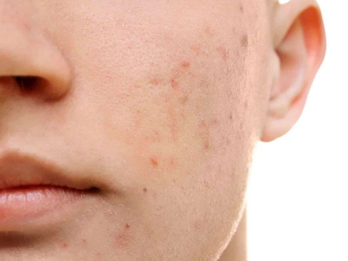 Việc xác định đúng loại da và tình trạng mụn sẽ giúp bạn chọn được serum phù hợp