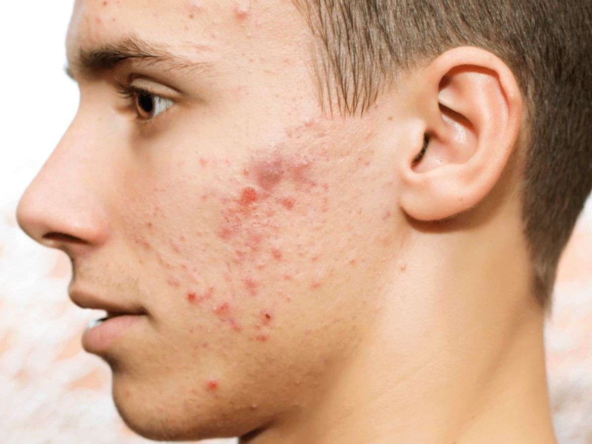 Da nam thường tiết nhiều dầu và dễ nổi mụn do nội tiết và thói quen cạo râu