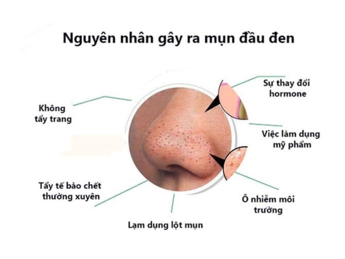Một số nguyên nhân gây mụn đầu đen ở nam giới 