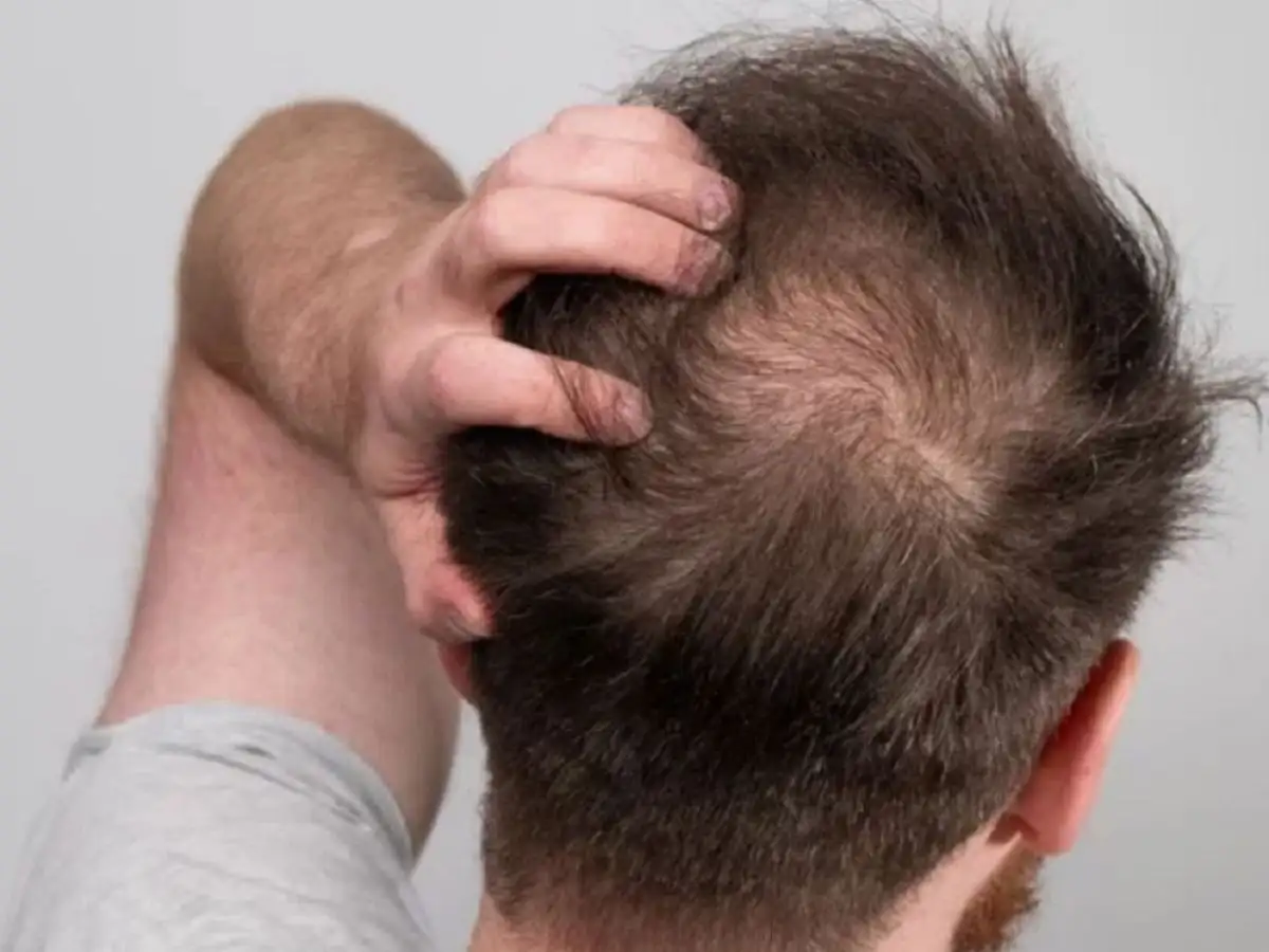 Tẩy tóc nhiều lần gây tổn thương nặng đến da đầu