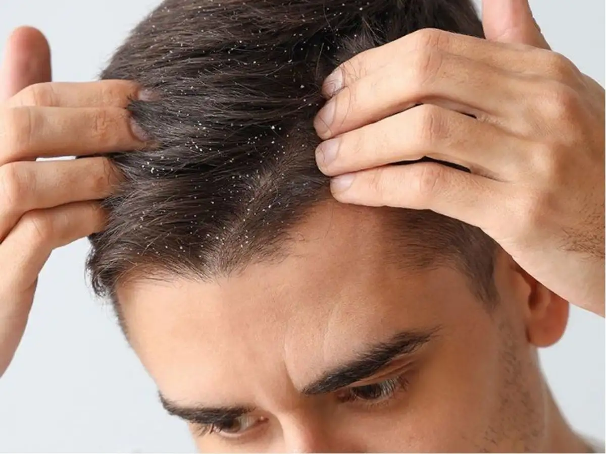 Tình trạng da đầu nam cũng ảnh hưởng lớn đến việc hình thành gàu