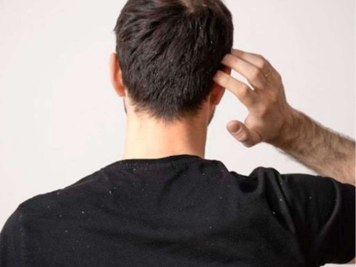 Dấu Hiệu Nhận Biết Gàu Trên Tóc Nam
