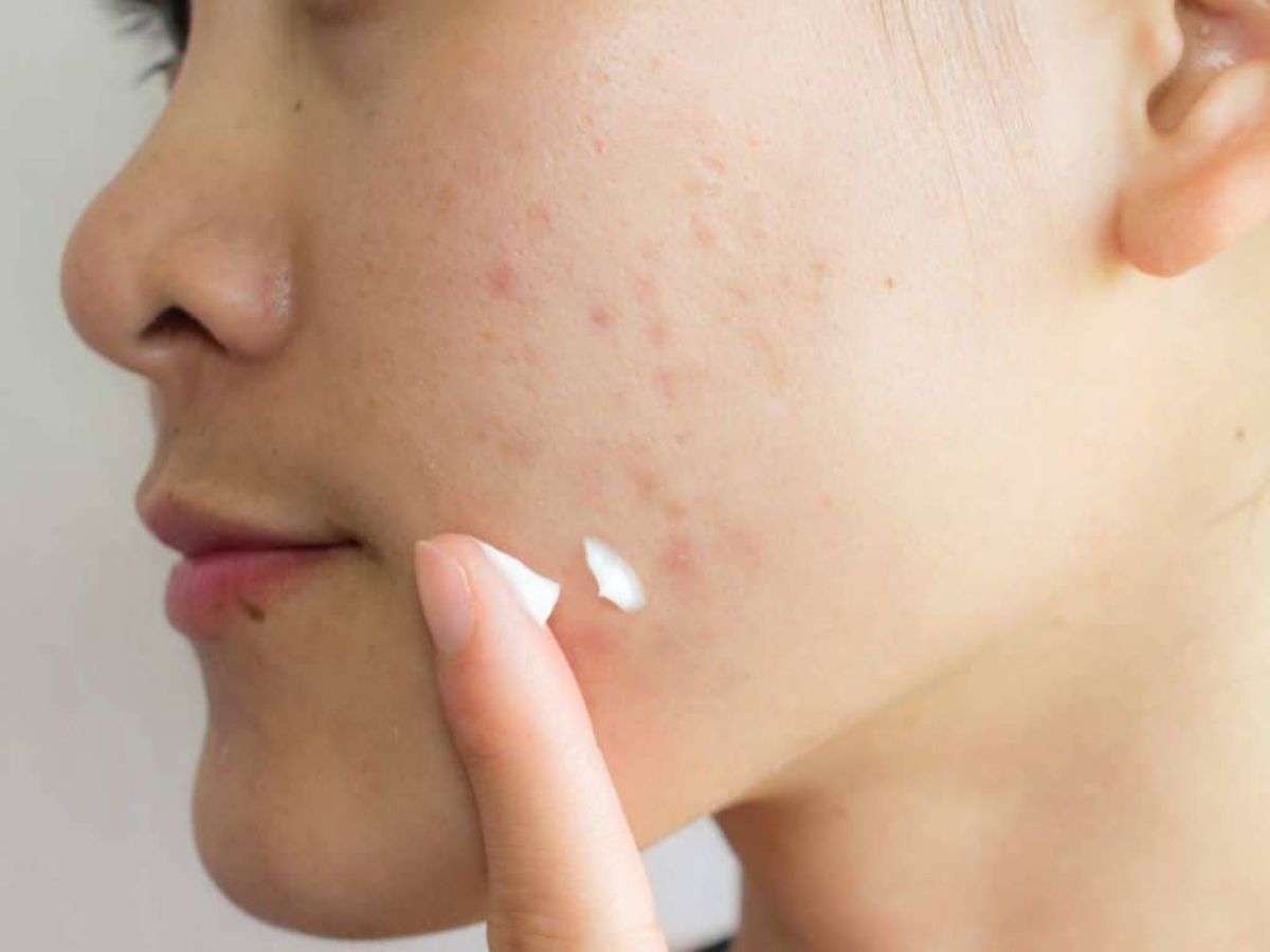 Sử dụng che khuyết điểm nhẹ nhàng đối với các vết thêm mụn 
