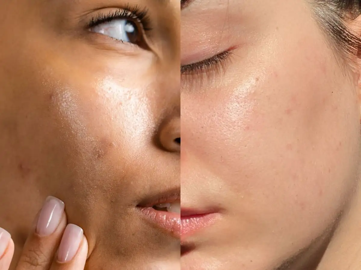 Da dầu là loại da có tuyến bã nhờn hoạt động mạnh