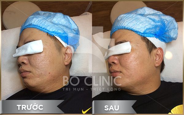 spa trị mụn cho nam tphcm