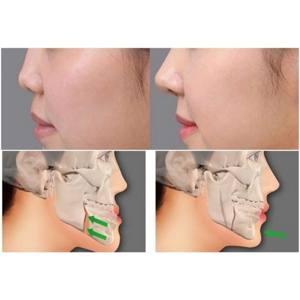 Mewing sử dụng các bài tập của lưỡi để giúp thay đổi kết cấu của khuôn mặt và khớp cắn
