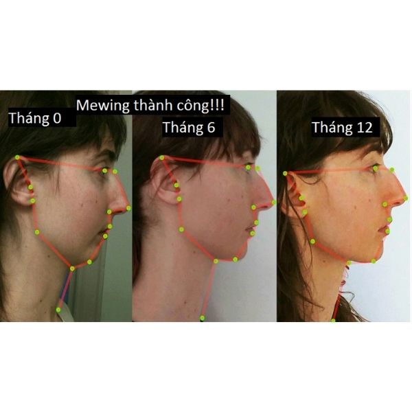 Việc tập Mewing giúp cải thiện các đường nét trên khuôn mặt của bạn