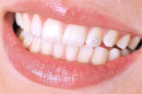 Đính kim cương vào răng đang là xu hướng làm đẹp được ưa chuộng trong thời gian gần đây
