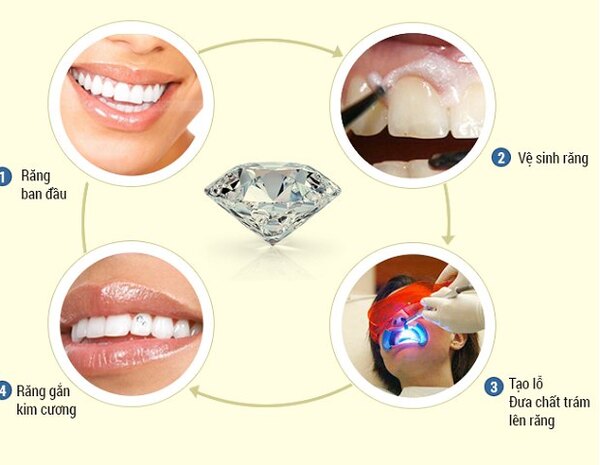 Quy trình đính kim cương vào răng cơ bản