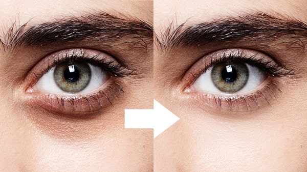 cách trị quầng thâm mắt trong 1 tuần cho nam 