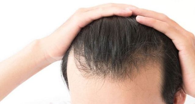 Nam giới đến tuổi dậy thì có thể bị rụng tóc không kiểm soát